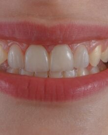 By the Skin of Your Teeth