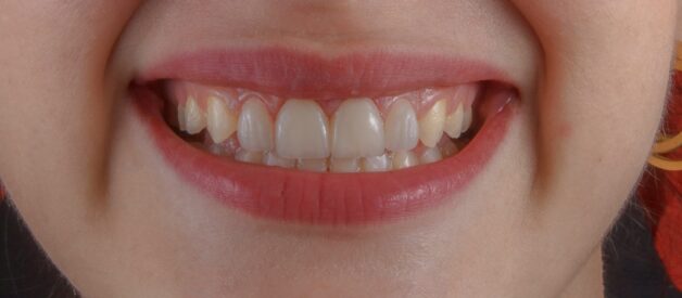 By the Skin of Your Teeth